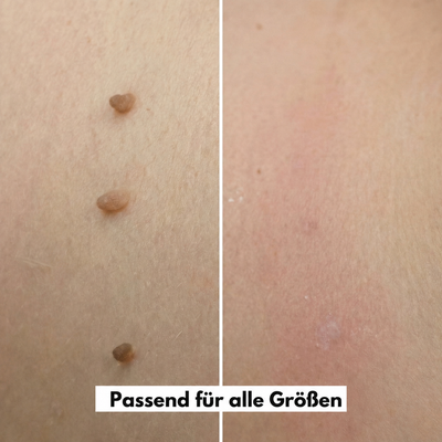 MediClear Plus™ Wieder Wohlfühlen in Deiner Haut