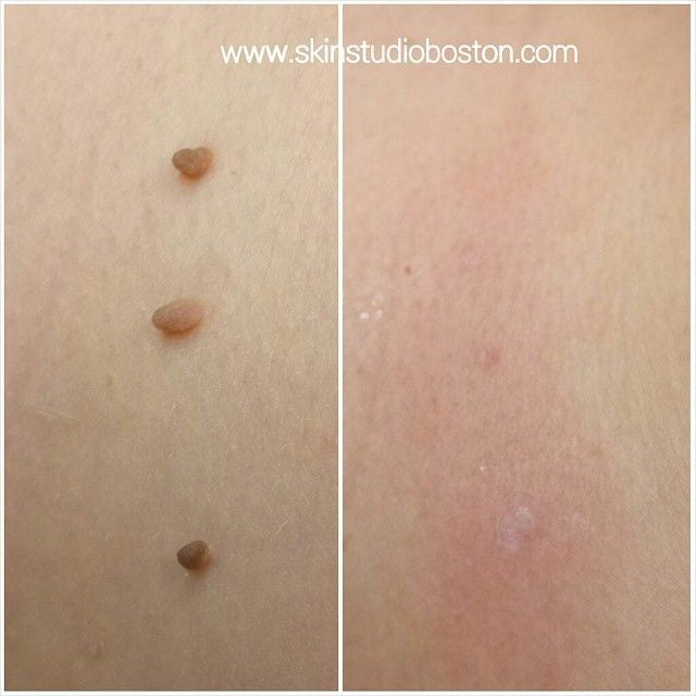 DermaSkin Pro™ – Schluss mit Hautanhängseln