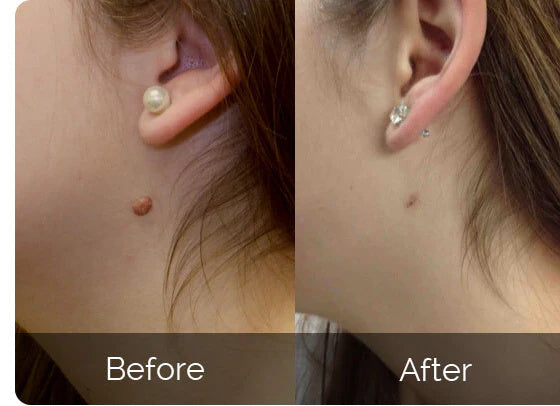 DermaSkin Pro™ – Schluss mit Hautanhängseln