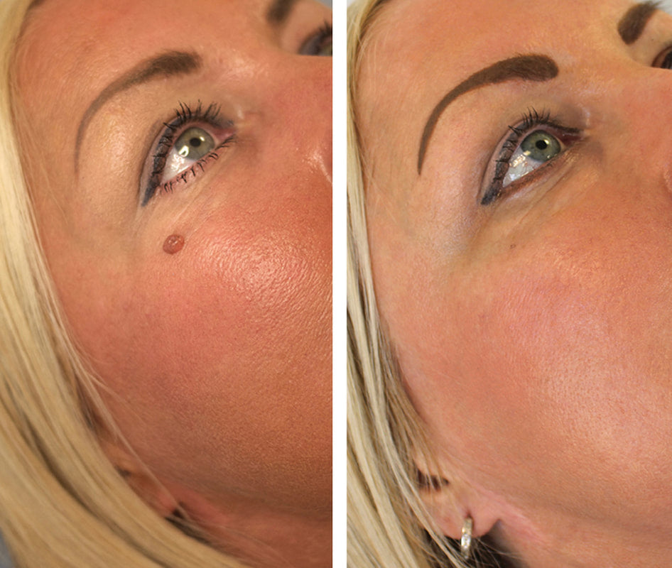 DermaSkin Pro™ – Schluss mit Hautanhängseln