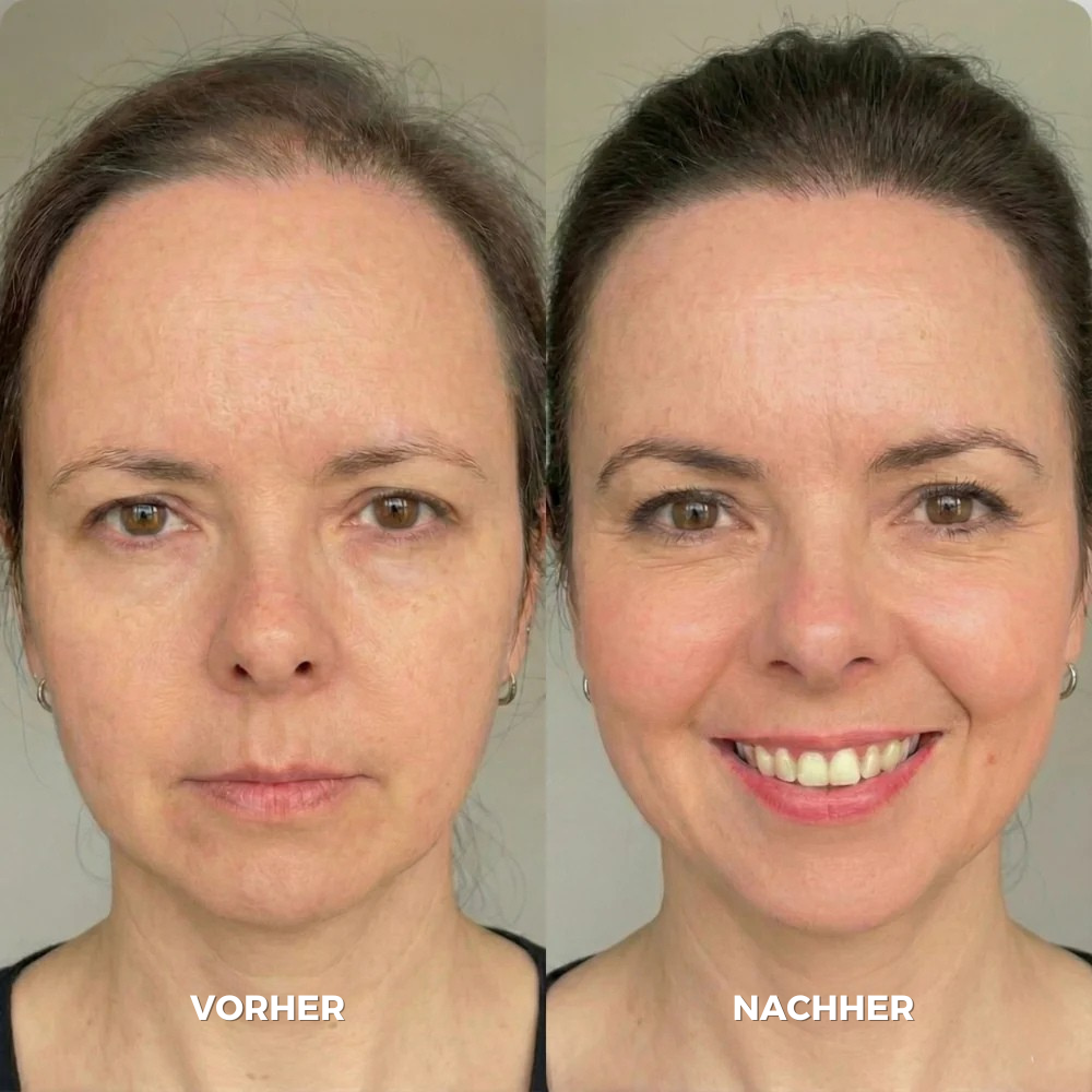 Glow Drops™ Mikronadel Pflege System